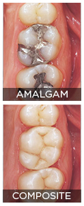 Posterior Composites